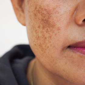 Pigmentation Care